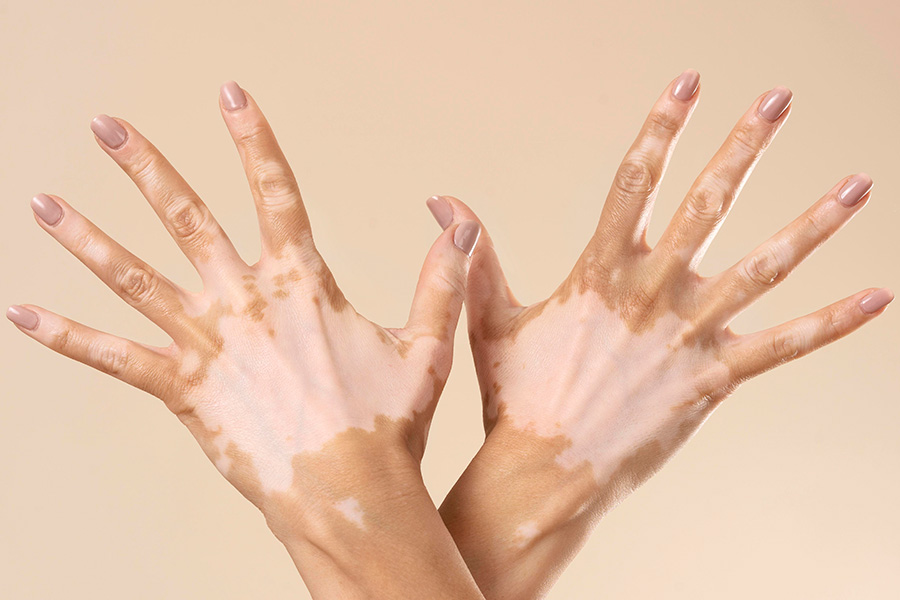 Mit kell tudni a vitiligóról?