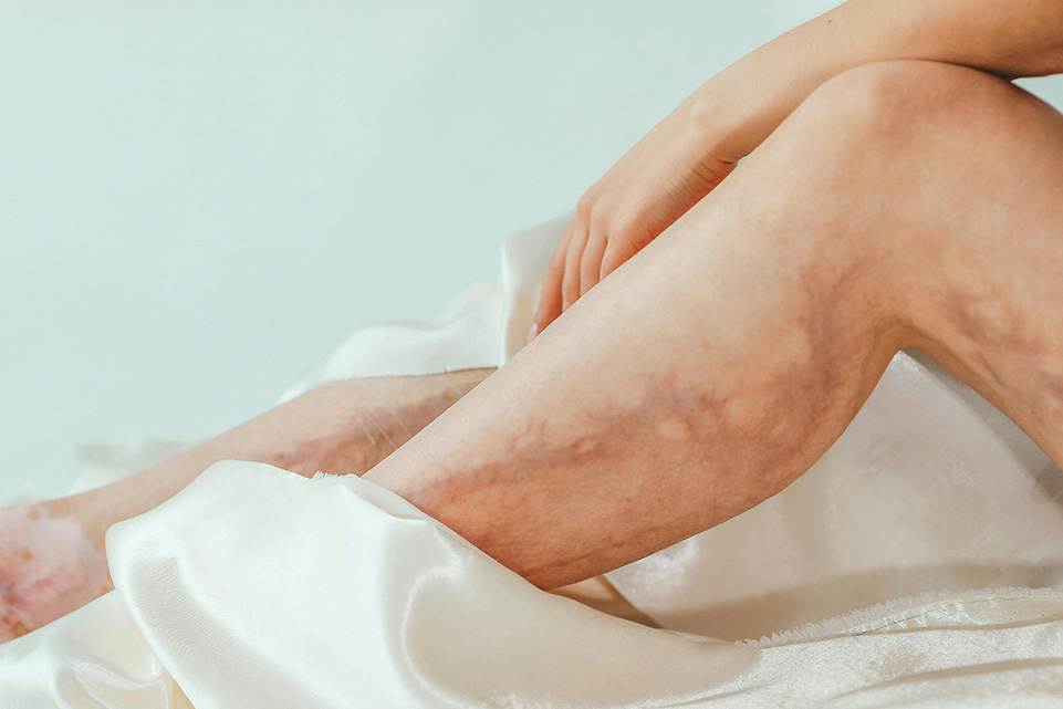 Visszérbetegségek: okok, megelőzés és korszerű kezelések